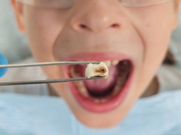 Best Emergency Wisdom Teeth Removal in Moundville, AL
